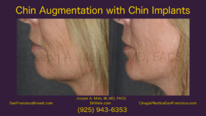Chin Augmentation Video with chin implant before and after pictures