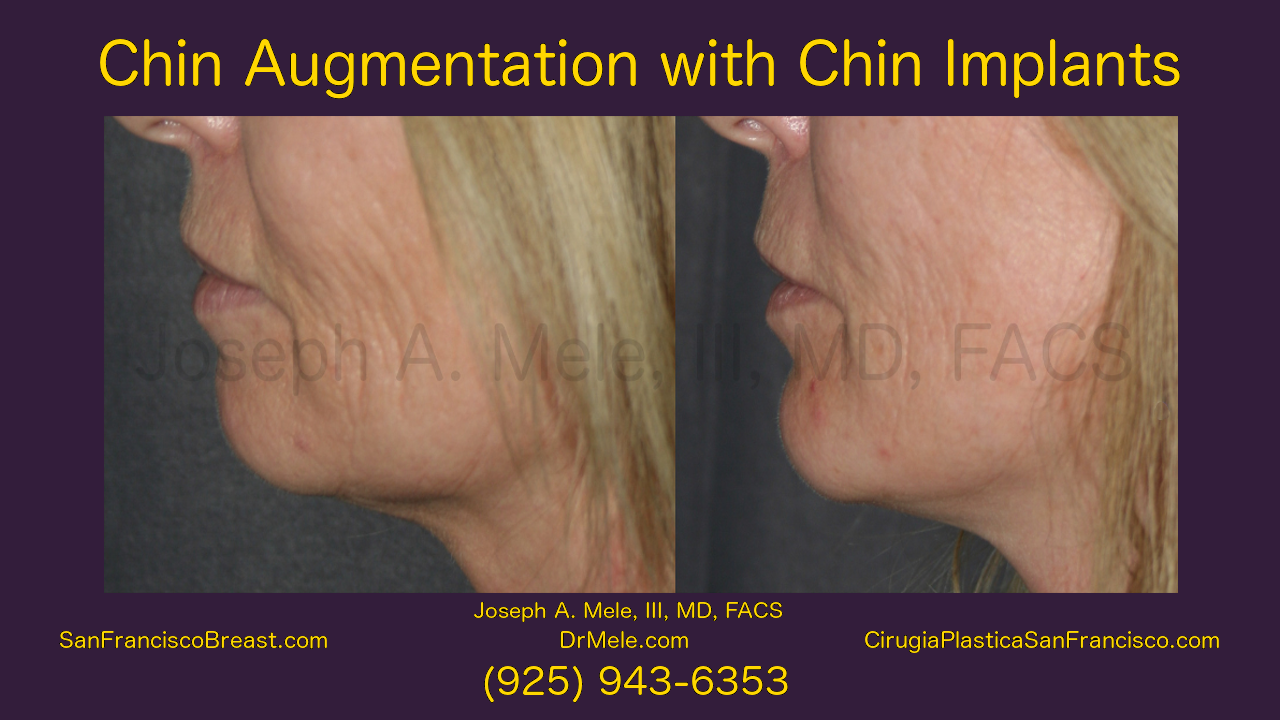 Chin Augmentation Video with chin implant before and after pictures