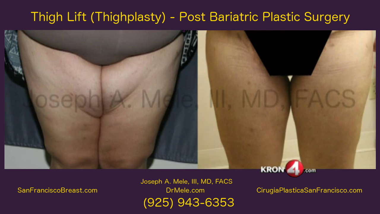 Thigh Lift Video with Thighplasty before and after pictures