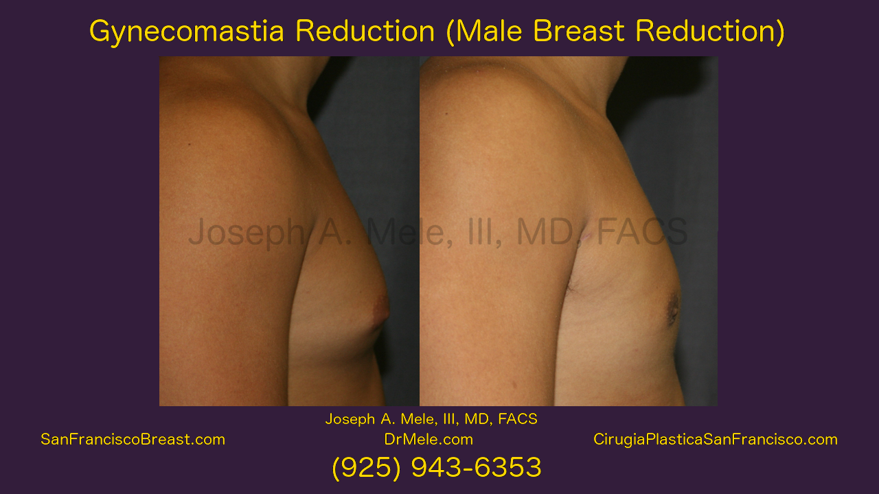 Gynecomastia Reduction Video with male breast reduction before and after pictures