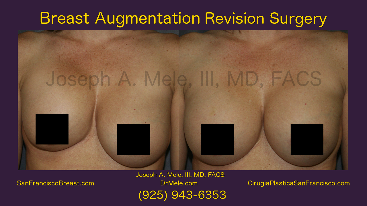 Breast Augmentation Revision Surgery Video with before and after pictures