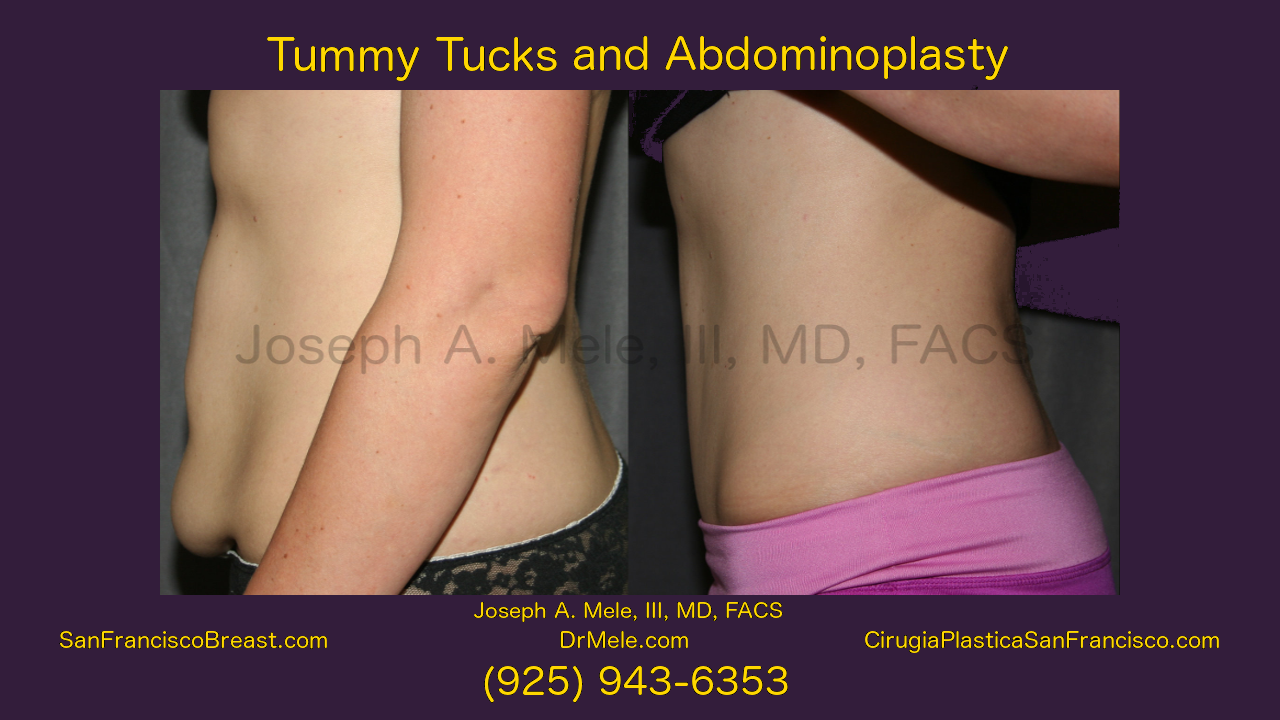 Tummy Tuck Video with Abdominoplasty before and after pictures