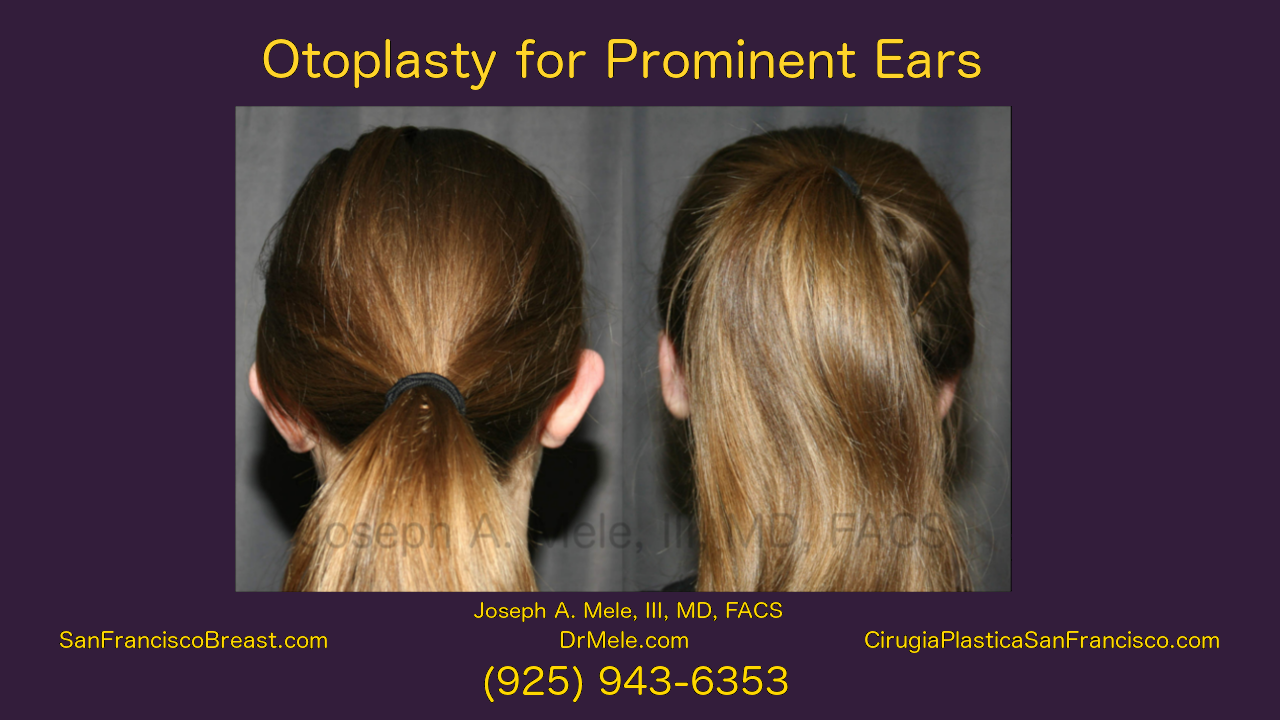 Otoplasty Video with Ear Pinning before and after pictures for prominent ears