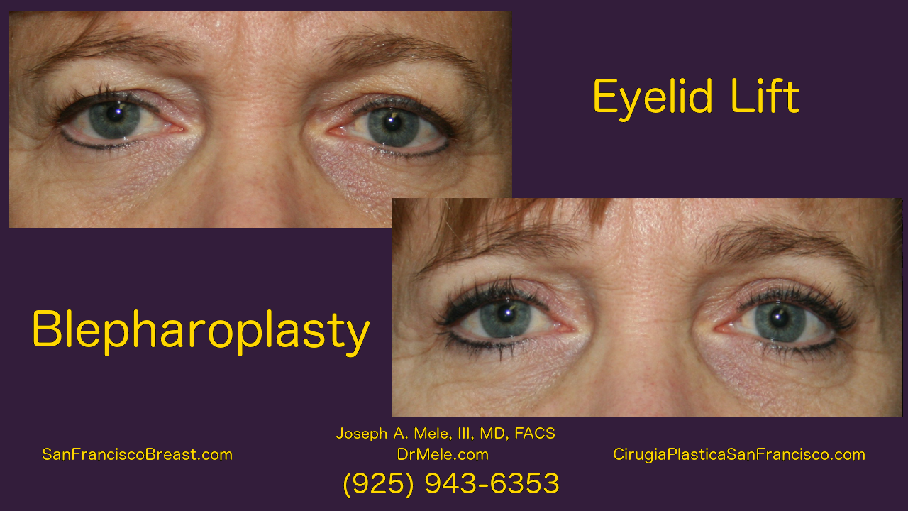 Eyelid Lift Video with Blepharoplasty before and after photos