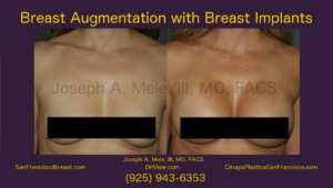 Breast Augmentation Video with Breast Implant before and after photos