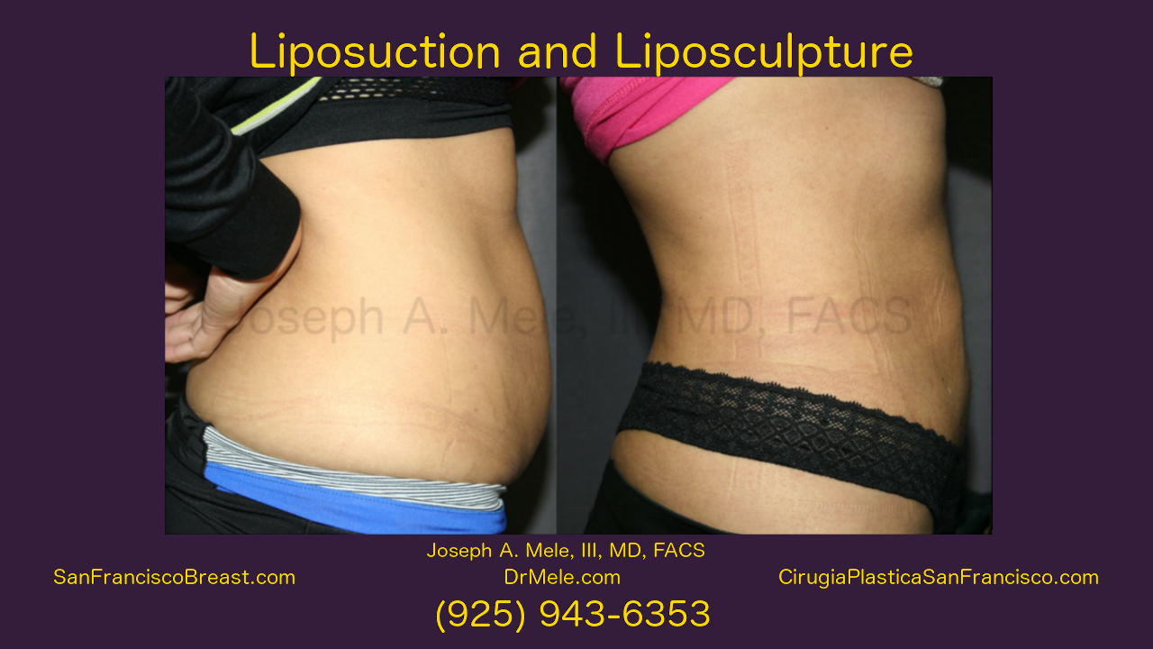 Tumescent Liposuction Video with Liposculpture before and after photos