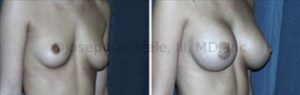 Breast Augmentation can help with pseudoptosis and asymmetry. The breasts appear bottomed out before surgery, with most the breast volume located below the nipple and mild pseudoptosis. The Breast Augmentation before and after pictures above show how Asymmetrical Breast Augmentation can correct the shape of the breasts and the size discrepancy. In this case, the right breast was smaller than the left before surgery, so a larger Breast Implants was used on the right.