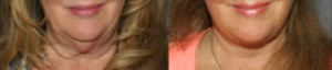 When the neck has loose skin without plcastymal bands, a Closed Neck Lift may be the best option. If disproportionate fat is present, Liposuction can be used to sculpt an even smoother contour.