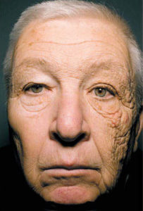 This long haul trucker has unilateral dermatoheliosis, which means one sided sun damage to his skin. With the sun shining through the driver's side window, over the years the left side of his face has received more sun exposure than the right side.