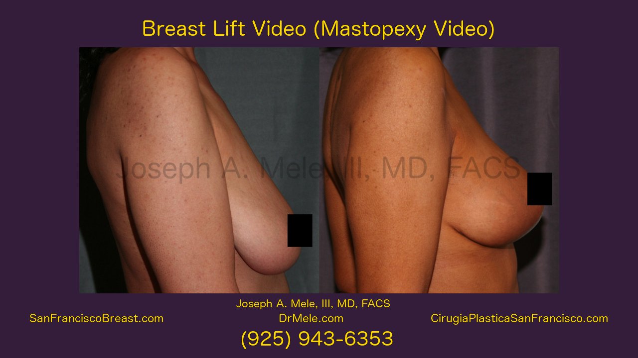 Breast Lift Video featuring Mastopexy before and after pictures