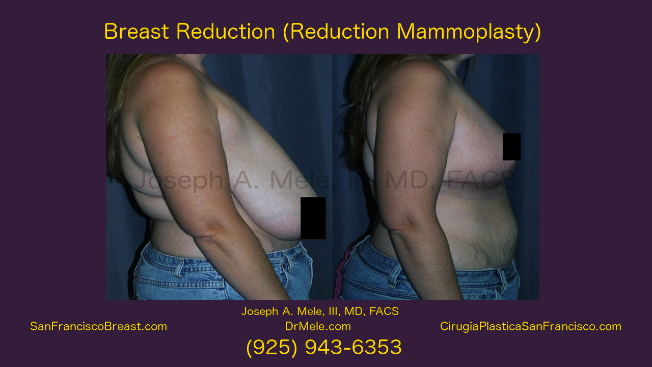 Breast Reduction Video with before and after pictures