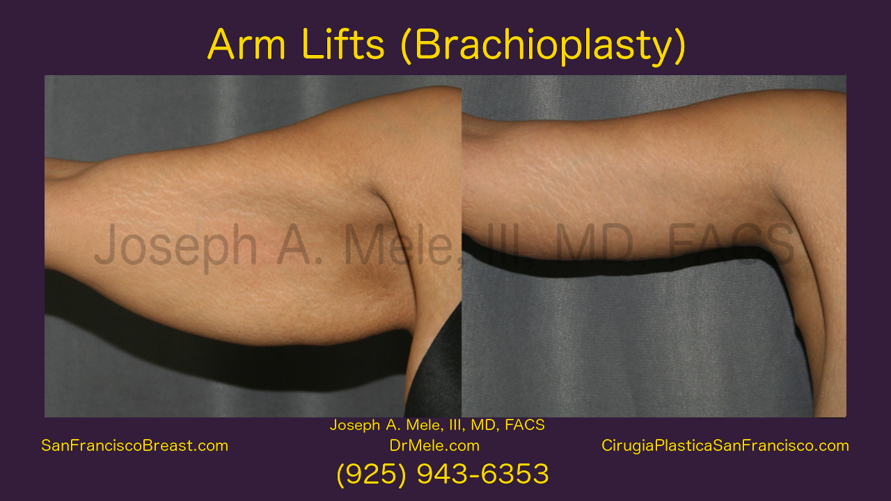 Arm Lift Video with Brachioplasty before and after pictures