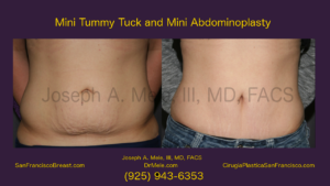 Mini Tummy Tuck Video with Mini Abdominoplasty before and after pictures