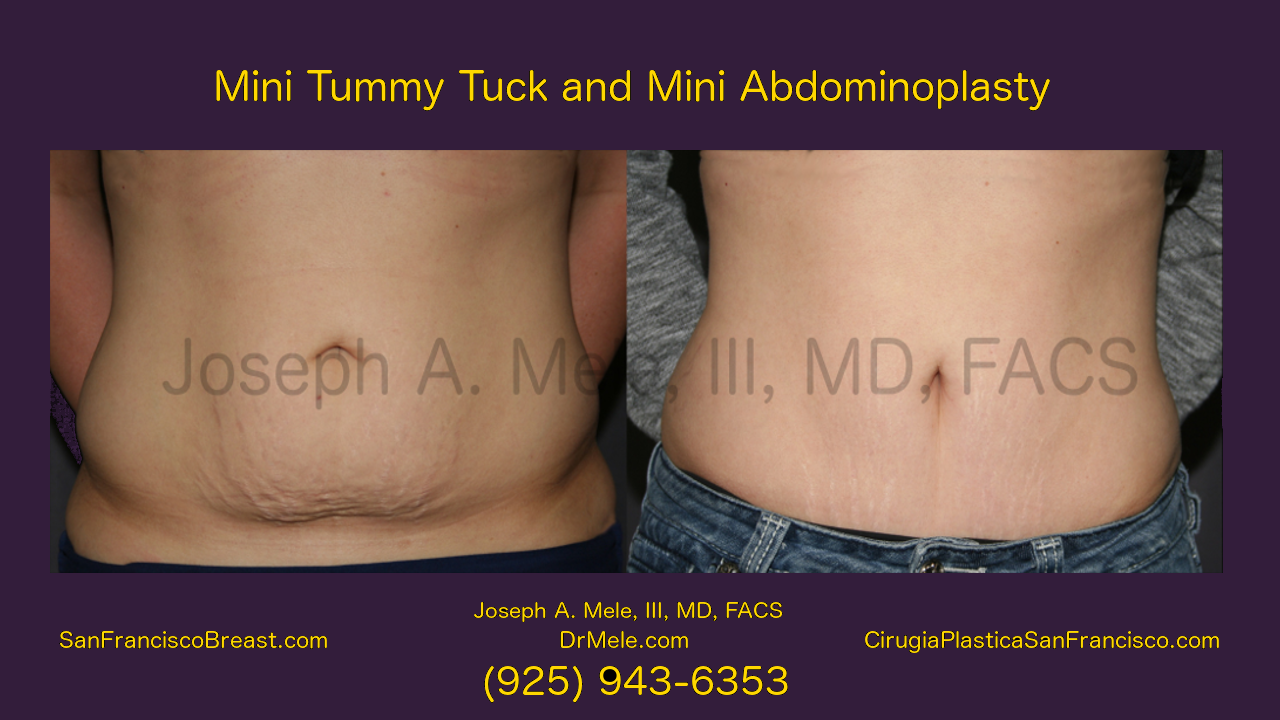 Mini Tummy Tuck Technique - Minneapolis, MN