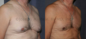 Gynecomastia Reduction: Sometimes the skin enveloping the breasts is redundant. This man has breast enlargement and sagging from his gynecomastia and loose skin. In this case, the breast tissue and the excess skin were removed through an incision that runs along the bottom of each breast. Without this, the skin would sag further over the inframammary fold from the loss of support caused by removing the chest's stuffing, just like deflating a balloon causes te balloon to fall over.