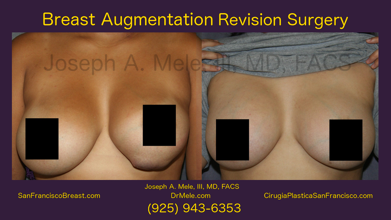 Breast Implant Revision Video with before and after photos