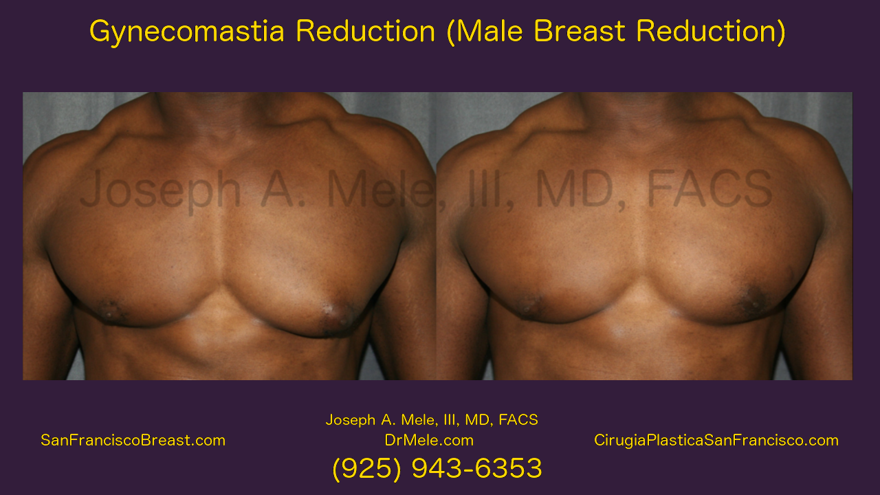 Male Breast Reduction Video with Gynecomastia Reduction before and after photos man boobs