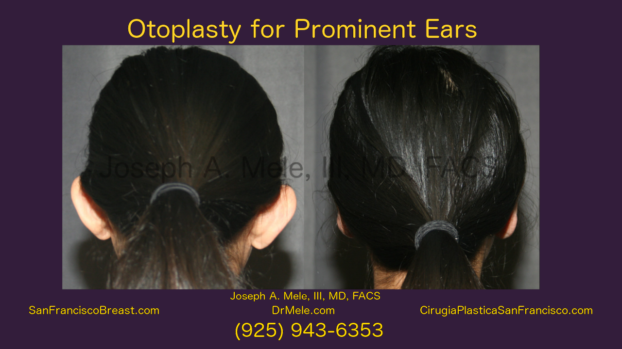 Otoplasty Video with cosmetic ear surgery before and after photos