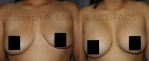 Breast Augmentation Revision Surgery - Stage II. The second stage entailed lowering the left implant pocket, expanding the lower, contracted pole of the left breast and asymmetrically augmentation the breasts to decrease the size difference.