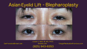Double Eyelid Surgery Video with Asoan Blepharoplasty before and after pictures