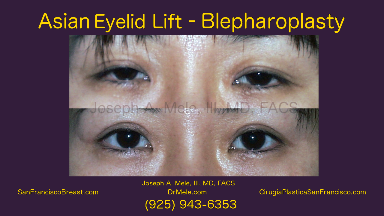 Double Eyelid Surgery Video with Asoan Blepharoplasty before and after pictures