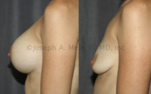 Breast Implant Removal Before and After Photos: Larger implants and less native breast tissue increase the desire for a Breast Lift after Breast Implant Removal Surgery. This patient above had large volume breast implants, small natural breast tissue volume, but good skin tone and nipple placement. She elected not to have a Breast Lift.