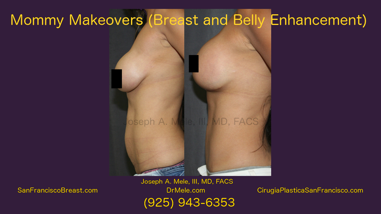 Mommy Makeover Video with Breast Augmentation before and after photos