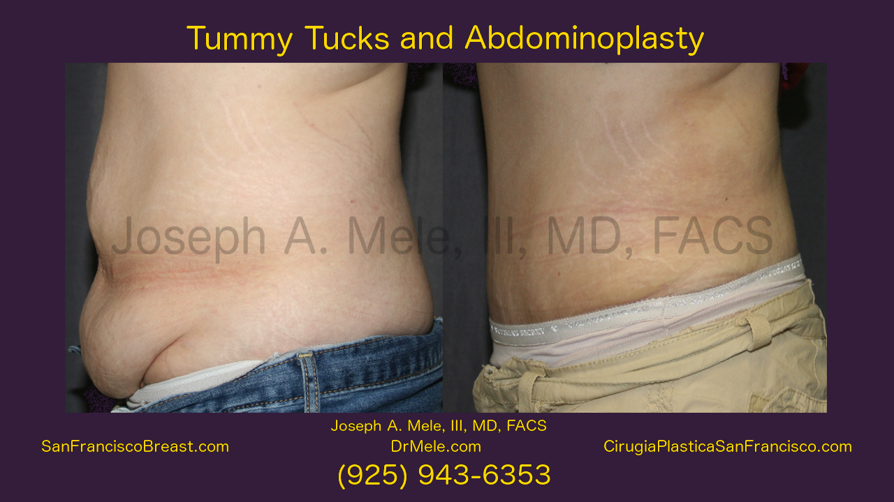 Abdominoplasty Video with Tummy Tuck before and after photos