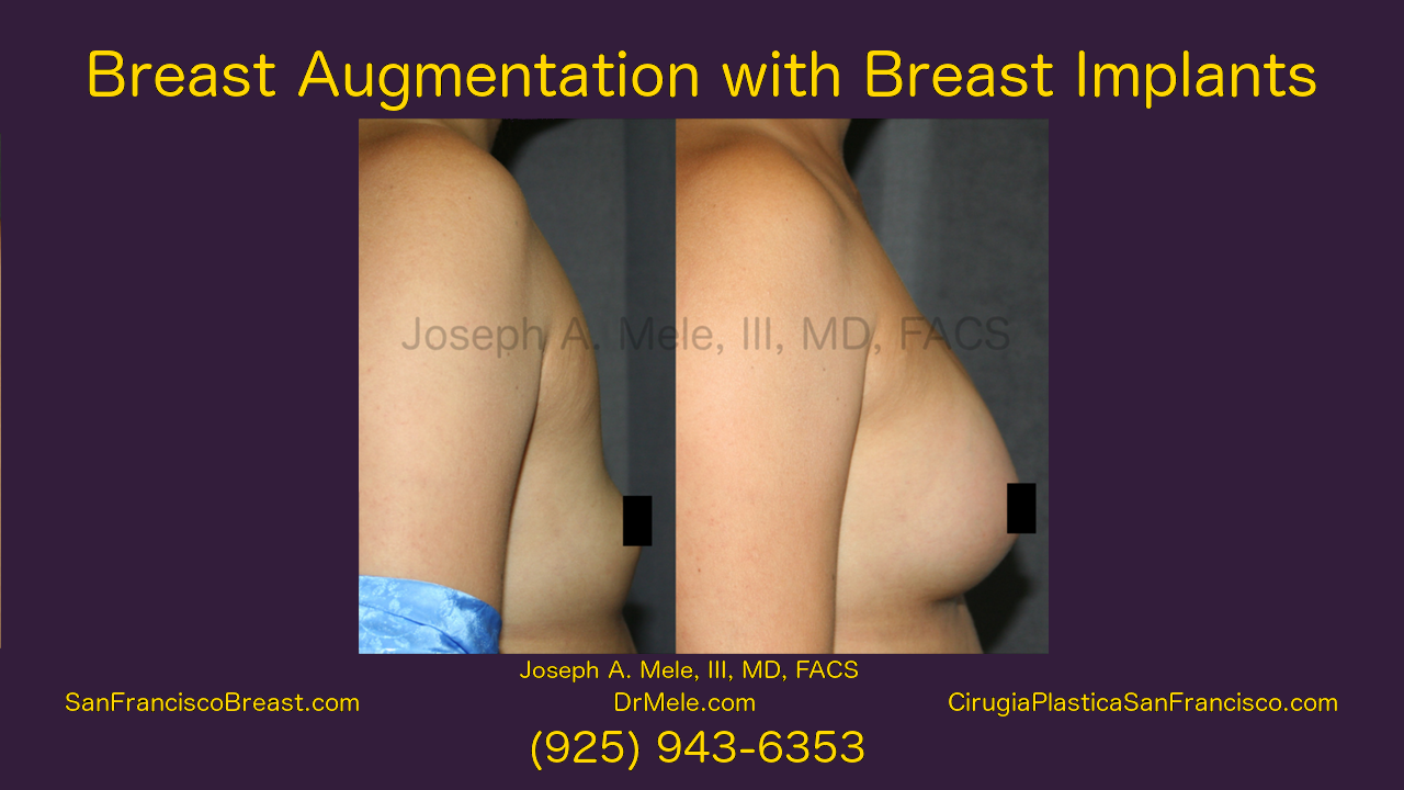 Breast Augmentation Video with Breast Implant before and after photos