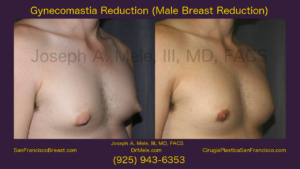 Male Breast Reduction Video with Gynecomastia Reduction before and after pictures