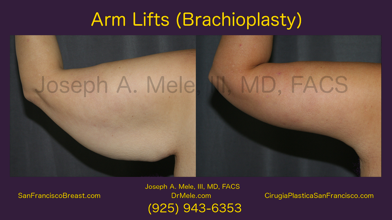 Arm Lift Video with Brachioplasty before and after pictures