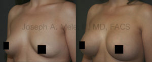 Breast implants come in a large variety of sizes and shapes. The best size for you is subjective; however, a Board Certified Plastic Surgeon can provide you with professional guidance in selecting the Breast Implant that will best provide the result you are looking for.