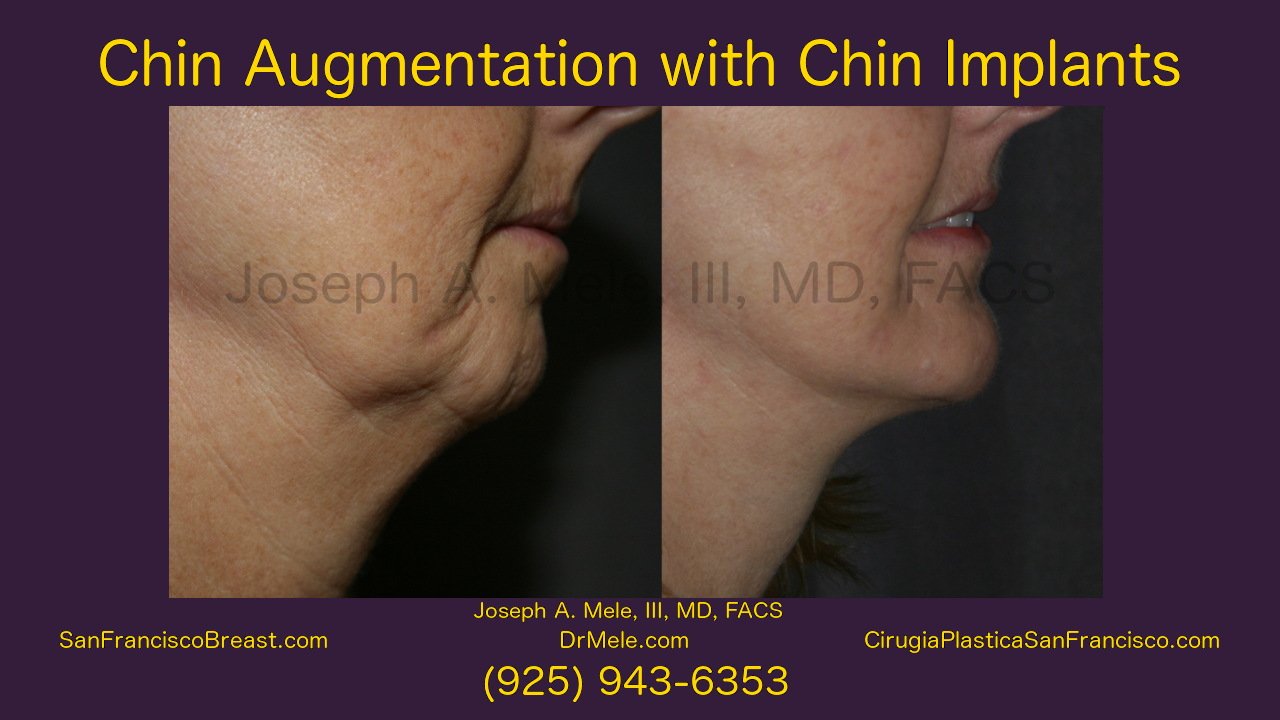 Chin Augmentation Video with Chin Implant before and after pictures