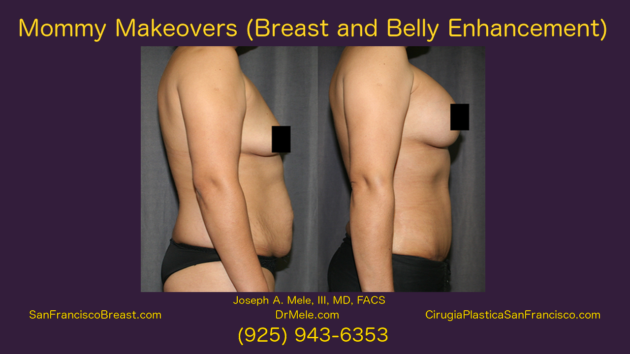 Mommy Makeover Video Presentation with Breast Augmentation and Tummy Tuck Before and After Pictures