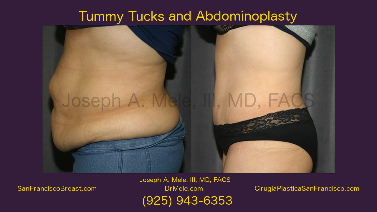 Tummy Tuck Video with Abdominoplasty Before and After Pictures