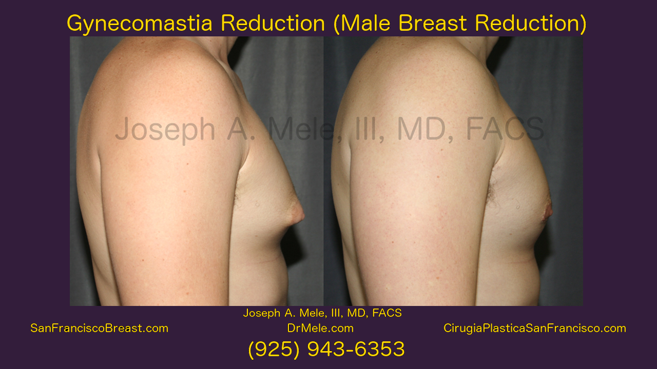Gynecomastia Reduction Video with Male Breast Reduction Before and After Pictures