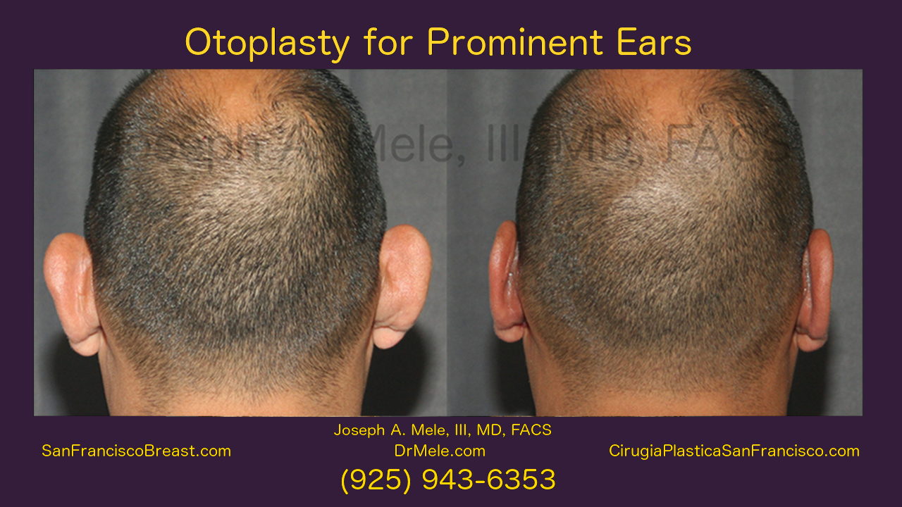 Otoplasty Video with Ear Pinning Before and After Pictures