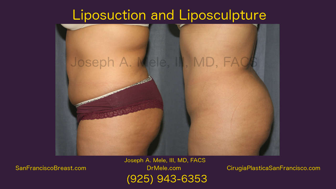 Liposuction Video – Liposculpture Video Presentation