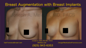 Breast Augmentation With Breast Implants Video Presentation