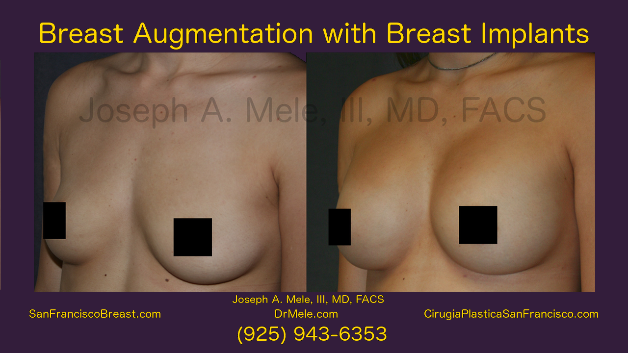 Breast Augmentation With Breast Implants Video Presentation