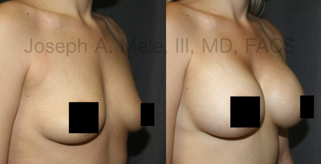 The best breast augmentation is achieved by selecting breast implants that are proportionate to the chest.