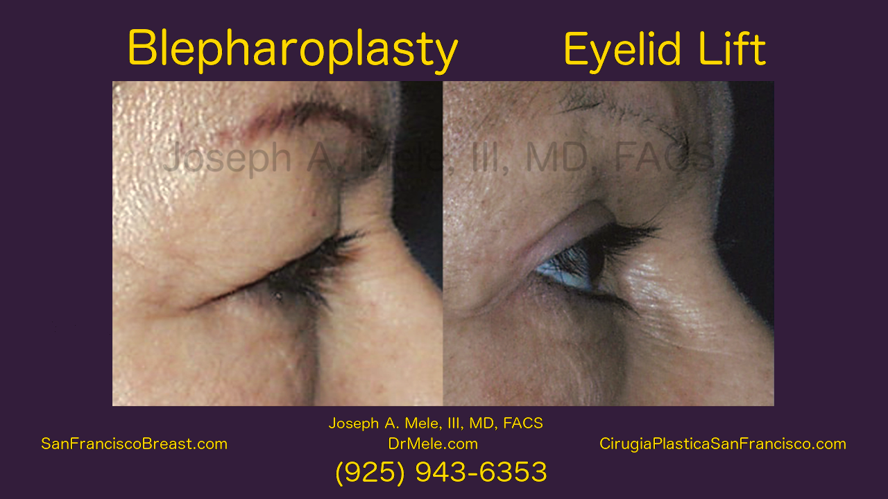 Blepharoplasty Video with Eyelid Lifts Before and After Photos