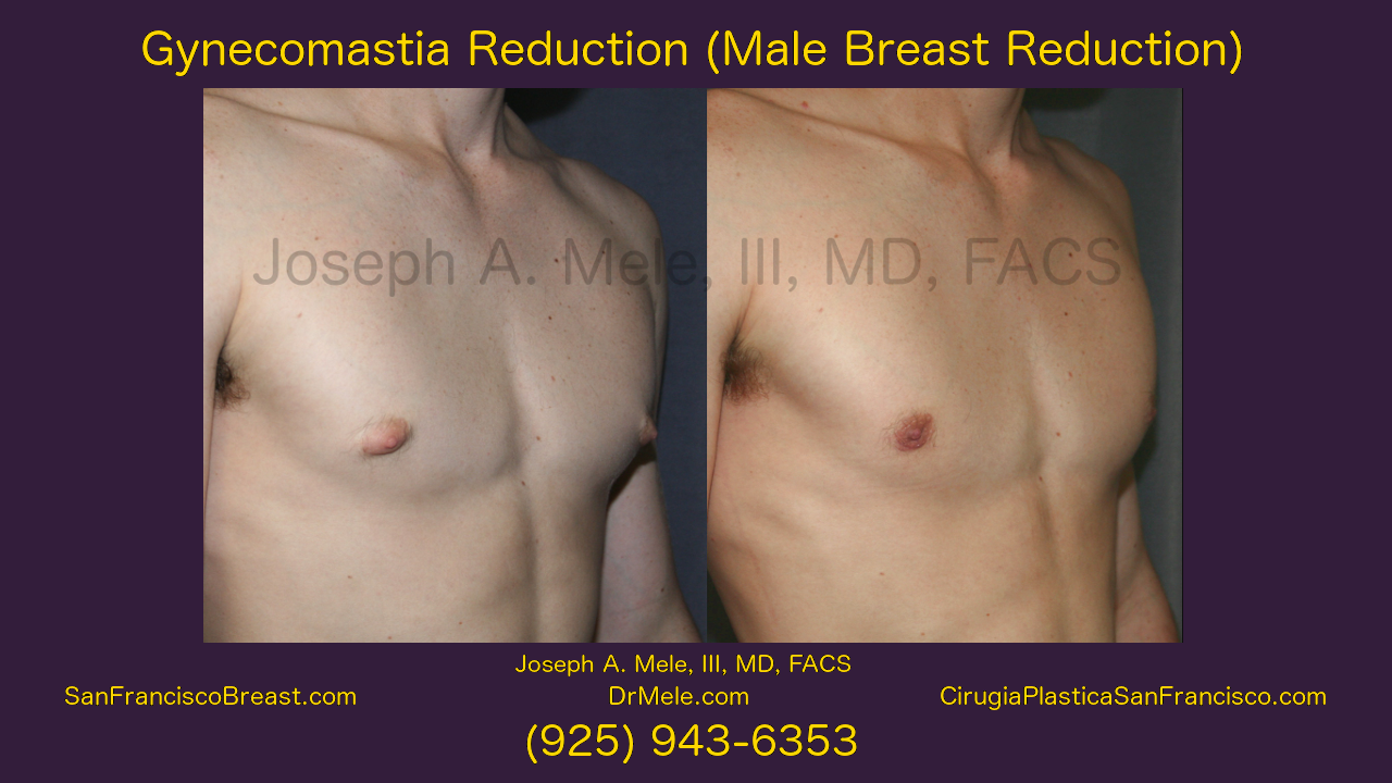 Gynecomastia Surgery (Male Breast Reduction) Video Presentation with Before and After Pictures