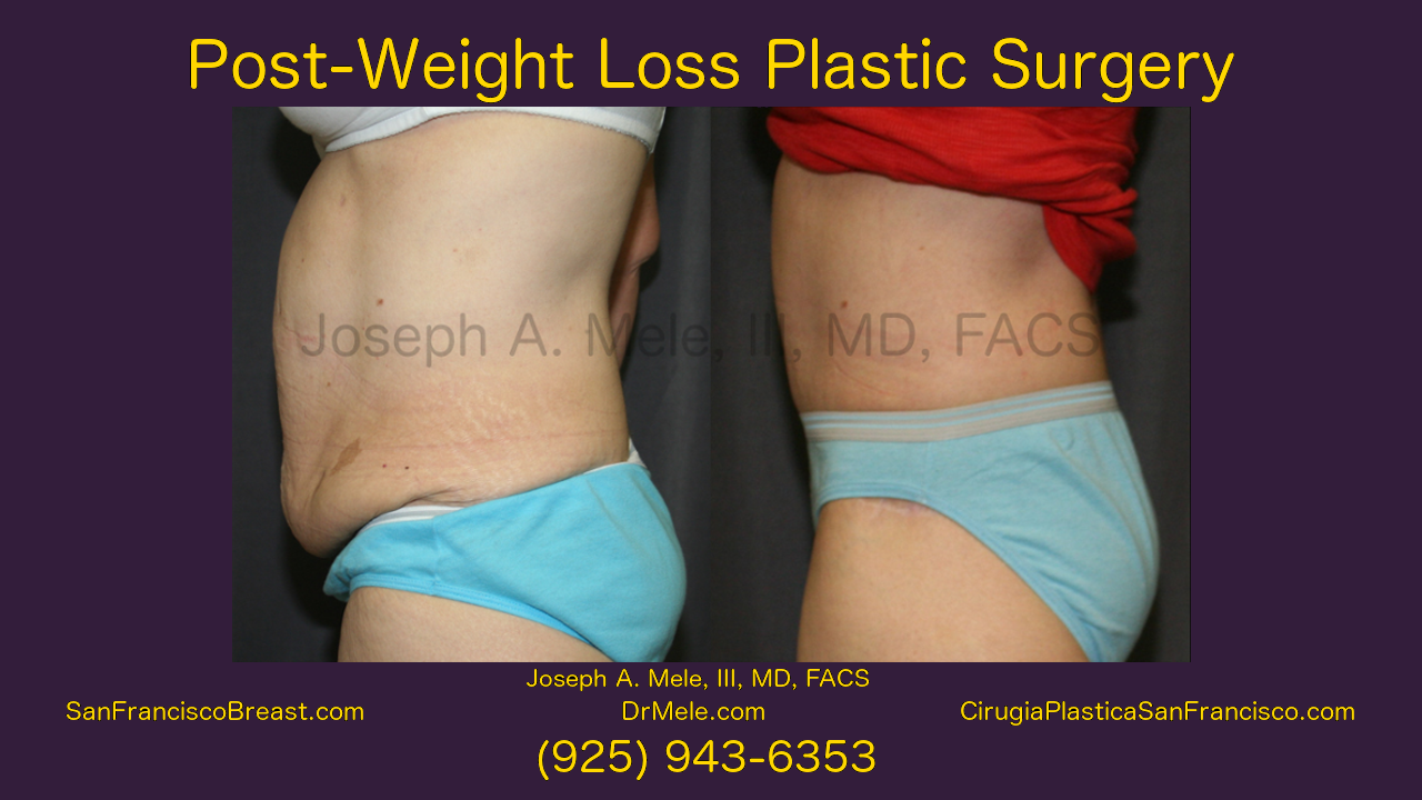 Post-Weight Loss Plastic Surgery Video with Post-Bariatric Plastic Surgery Before and After Pictures