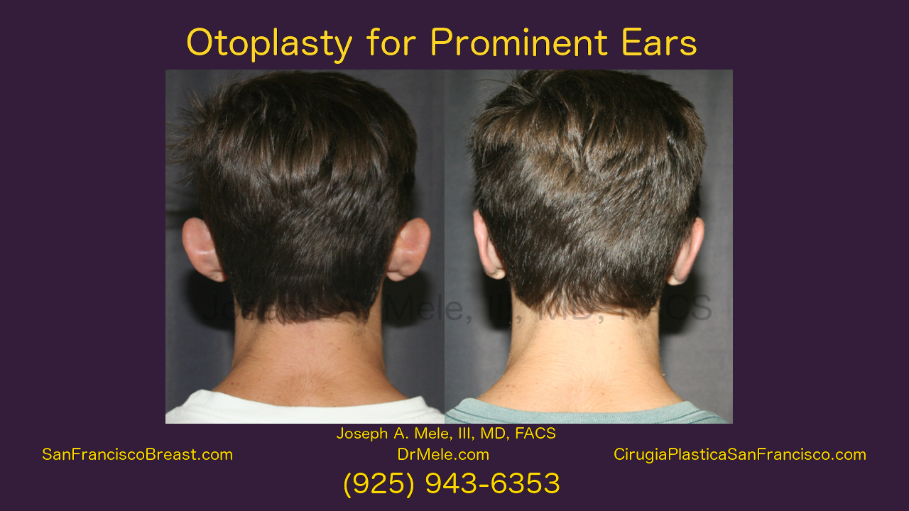 Cosmetic Ear Surgery Video with Otoplasty Before and After Pictures