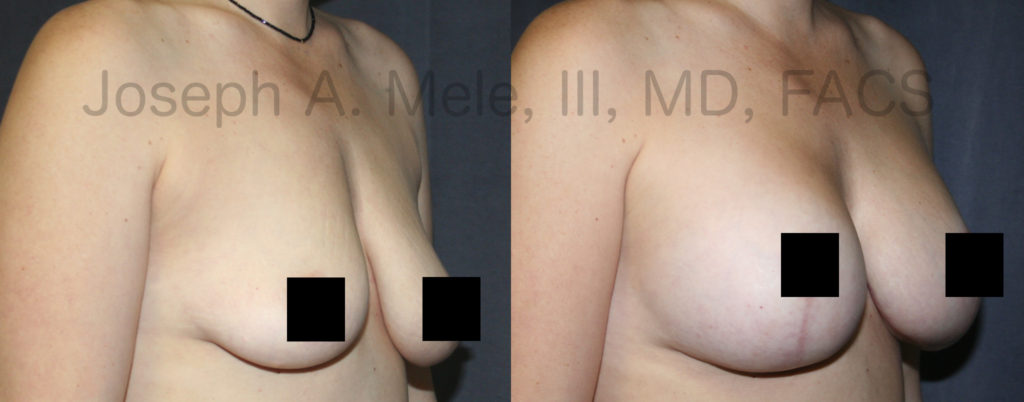 Deflated, post child birth or post weight loss breasts can be lifted, tightened and enlarged with the breast enhancing Mastopexy Augmentation. Larger lifts require longer scars. In this case, the healing vertical scar is seen on the lower pole of the breast. After this breast augmentation mastopexy, the breasts are fuller, firmer and lifted.