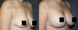 Deflated, post child birth or post weight loss breasts can be lifted, tightened and enlarged with the breast enhancing Mastopexy Augmentation.