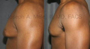 With good skin tone, even large breast reductions can be performed through small, minimally invasion incisions.