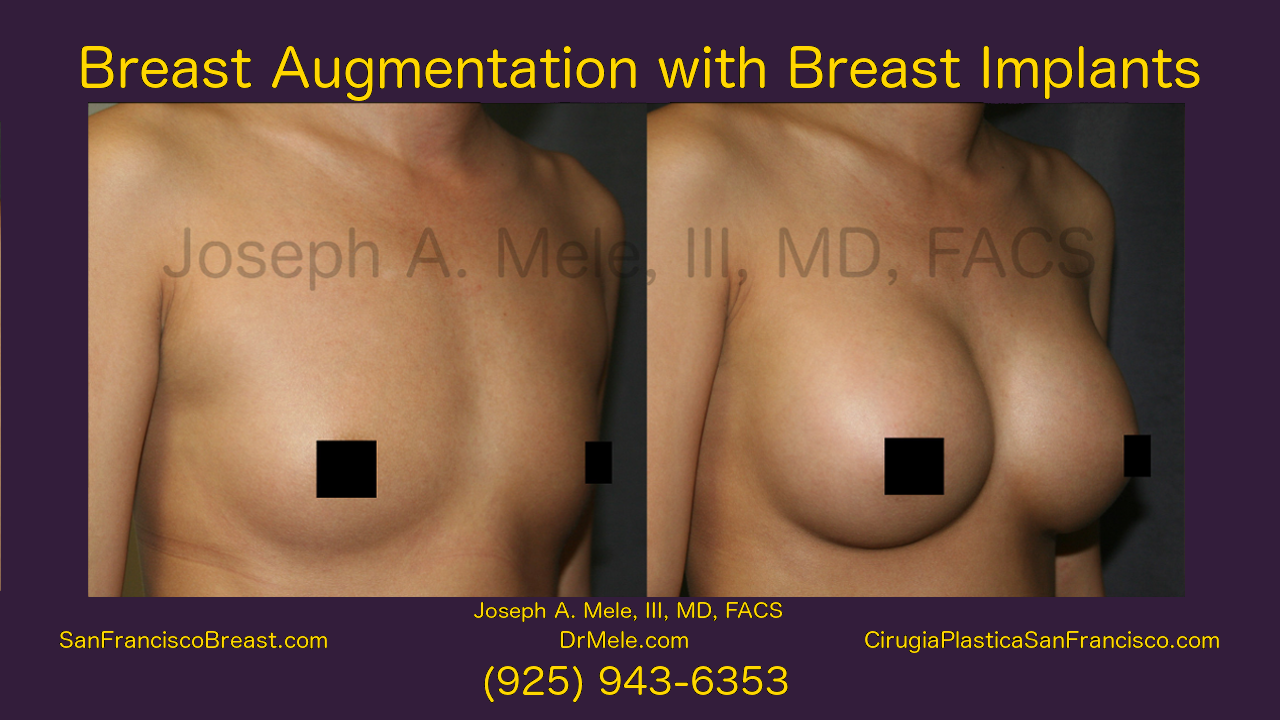 Breast Augmentation Video with Gummy Bear Breast Implants Before and After Pictures