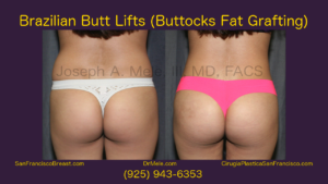 Brazilian Butt Lift Video with Buttocks Fat Grating Before and After Pictures